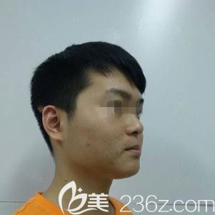 在天伊美整形做光子嫩膚術前皮膚粗糙 在天伊美整形做光子嫩膚術前皮膚粗糙