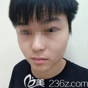 我用光子嫩膚前后對比照片告訴你石家莊天伊美做激光嫩膚效果如何