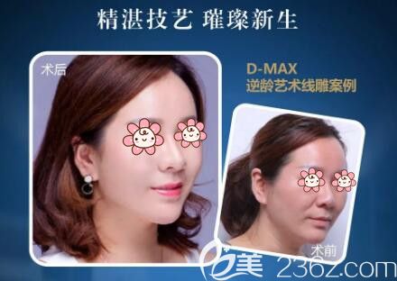 D-MAX逆齡藝術(shù)線雕真人前后對比照