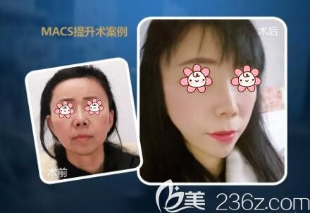 MACS提拉術(shù)真人前后效果對比