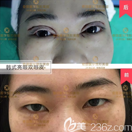 攀枝花奇麗韓式雙眼皮術(shù)后即刻效果圖