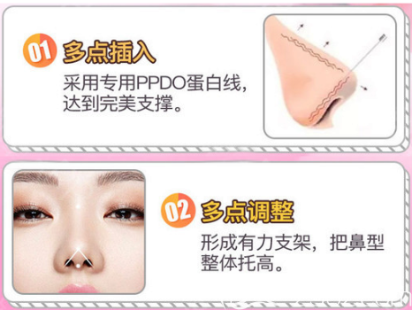 廣州紫馨于曉強線雕隆鼻手術特點 廣州紫馨于曉強線雕隆鼻手術特點