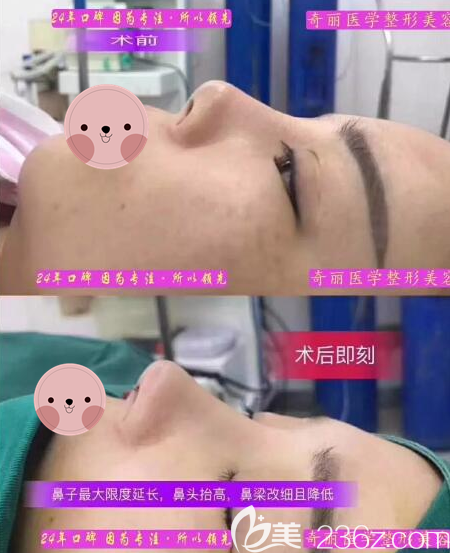 攀枝花奇麗鼻綜合術(shù)后對比效果圖