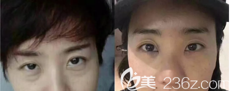 攀枝花奇麗整形美容祛眼袋術(shù)前術(shù)后對比圖