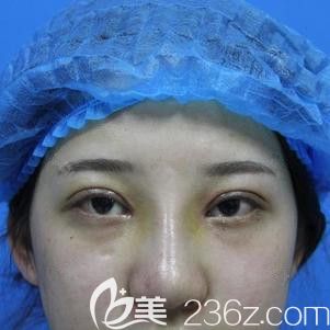 張柏松醫(yī)生為我剛做完雙眼皮手術后有點腫脹 張柏松醫(yī)生為我剛做完雙眼皮手術后有點腫脹