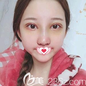 在天伊美整形做切開雙眼皮術后7天進行拆線 在天伊美整形做切開雙眼皮術后7天進行拆線