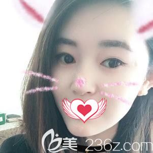 在石家莊天伊美做隆下巴手術(shù)10天下巴微腫 在石家莊天伊美做隆下巴手術(shù)10天下巴微腫