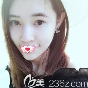 <!--<i data=20240703-sp></i>-->醫(yī)生為我做硅膠墊下巴術(shù)后22天變小V臉 <!--<i data=20240703-sp></i>-->醫(yī)生為我做硅膠墊下巴術(shù)后22天變小V臉