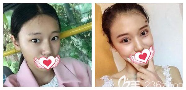 曲靖靖美張金明做全切雙眼皮案例效果對(duì)比圖