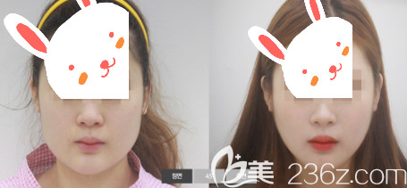 我在西安做磨骨手術(shù)的前后對比圖