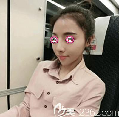 劉文峰醫(yī)生給我做鼻整形修復(fù)第10天樣子