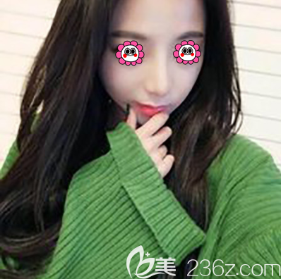 北京紫潔醫(yī)美鼻整形修復(fù)案例