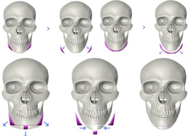 韓國(guó)H醫(yī)院下頜角整形手術(shù)方法