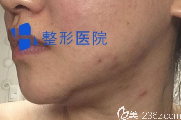 韓國(guó)H整形下頜角修復(fù)術(shù)前照片