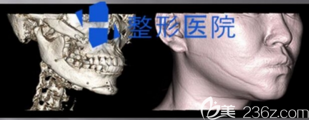 韓國(guó)H整形下頜角修復(fù)術(shù)前CT圖片