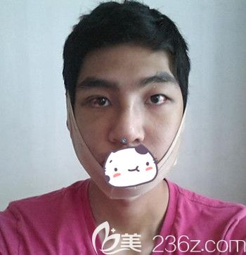 在韓國JJ洪鎮(zhèn)柱整形外科做面部輪廓+眼鼻整形手術(shù)后1周 在韓國JJ洪鎮(zhèn)柱整形外科做面部輪廓+眼鼻整形手術(shù)后1周