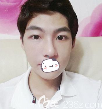 在韓國JJ洪鎮(zhèn)柱整形外科做面部輪廓+眼鼻整形手術(shù)后1個月 在韓國JJ洪鎮(zhèn)柱整形外科做面部輪廓+眼鼻整形手術(shù)后1個月