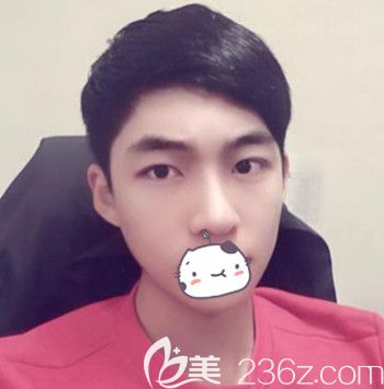 在韓國JJ洪鎮(zhèn)柱整形外科做面部輪廓+眼鼻整形手術(shù)后3個月 在韓國JJ洪鎮(zhèn)柱整形外科做面部輪廓+眼鼻整形手術(shù)后3個月