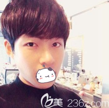 在韓國JJ洪鎮(zhèn)柱整形外科做面部輪廓+眼鼻整形手術(shù)后6個月 在韓國JJ洪鎮(zhèn)柱整形外科做面部輪廓+眼鼻整形手術(shù)后6個月