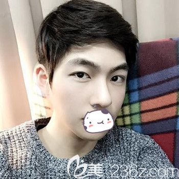 公開我在韓國JJ洪鎮(zhèn)柱整形外科做面部輪廓+眼鼻整形手術后1年的后記