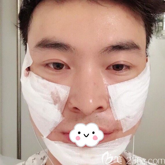 韓國(guó)JK整形面部輪廓三件套術(shù)后第2天效果圖