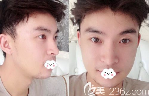 韓國(guó)JK整形金成植顴骨+下頜角+下巴整形案例