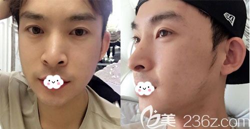 韓國(guó)JK整形面部輪廓整形術(shù)后1個(gè)月恢復(fù)照片