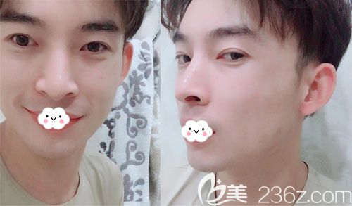 找2019有名氣的整形醫(yī)院韓國(guó)JK整形金成植做面部輪廓三件套后都說(shuō)顴骨降低的我像枚小仙肉