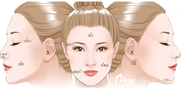 自體脂肪填充面部示意圖圖 自體脂肪填充面部示意圖圖