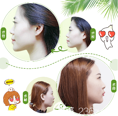 北京純脂醫(yī)療馮斌醫(yī)生自體脂肪墊下巴 北京純脂醫(yī)療馮斌醫(yī)生自體脂肪墊下巴