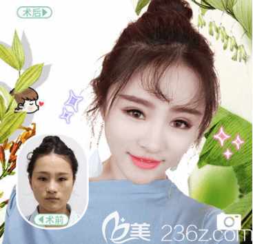 北京純脂醫(yī)療美容王自謙自體脂肪面部填充 北京純脂醫(yī)療美容王自謙自體脂肪面部填充