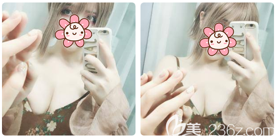 在廣州韓妃做完自體脂肪隆胸一個月效果 在廣州韓妃做完自體脂肪隆胸一個月效果