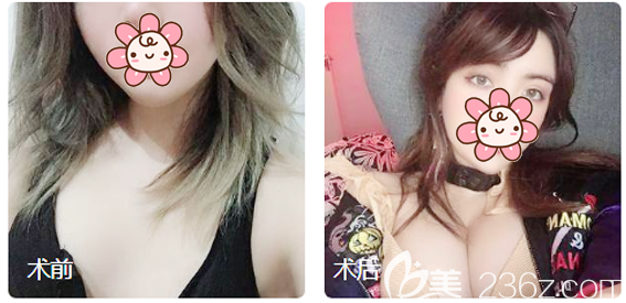廣州韓妃楊偉杰自體脂肪隆胸案例對比圖 廣州韓妃楊偉杰自體脂肪隆胸案例對比圖