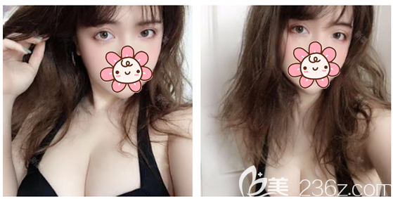 廣州韓妃自體脂肪豐胸兩個月自拍 廣州韓妃自體脂肪豐胸兩個月自拍