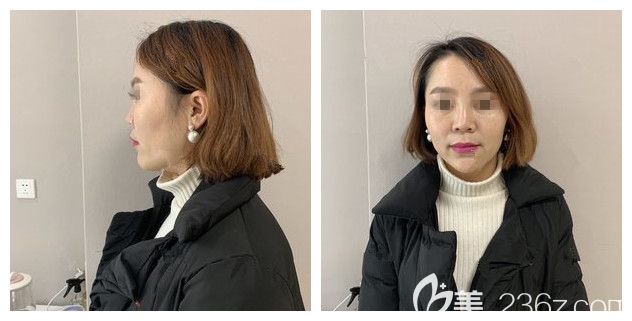 面診蘇州紫馨醫(yī)生術(shù)前塌鼻子 面診蘇州紫馨醫(yī)生術(shù)前塌鼻子