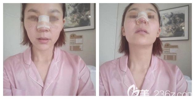 剛做完半肋軟骨隆鼻術(shù)后即刻恢復(fù) 剛做完半肋軟骨隆鼻術(shù)后即刻恢復(fù)