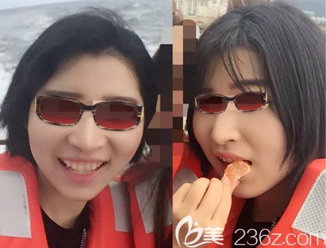 韓國釜山哈娜爾整形醫(yī)院金成浩院長顴骨內(nèi)推真人案例 韓國釜山哈娜爾整形醫(yī)院金成浩院長顴骨內(nèi)推真人案例