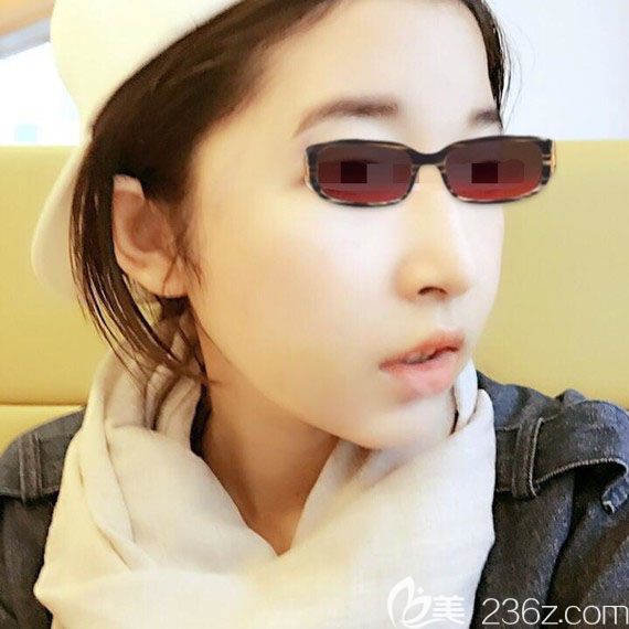 韓國釜山哈娜爾金成浩面部輪廓案例術(shù)后12天恢復(fù)效果圖 韓國釜山哈娜爾金成浩面部輪廓案例術(shù)后12天恢復(fù)效果圖