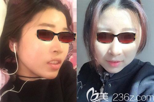 整顴骨韓國(guó)哪個(gè)醫(yī)生好？我找韓國(guó)釜山哈娜爾整形金成浩做顴骨內(nèi)推4個(gè)月恢復(fù)效果圖