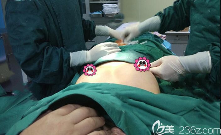 自體脂肪填充豐胸手術(shù)中 自體脂肪填充豐胸手術(shù)中