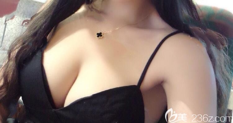 合肥福華整形自體脂肪隆胸術(shù)后第14天 合肥福華整形自體脂肪隆胸術(shù)后第14天