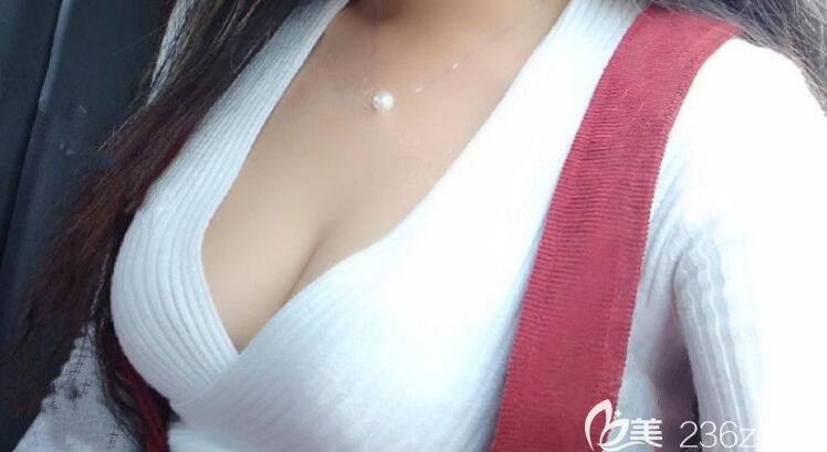 再次找合肥福華整形趙章杰做自體脂肪填充豐胸，正好趕上福華年中盤(pán)點(diǎn)隆胸價(jià)格很優(yōu)惠