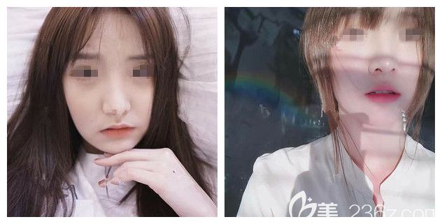 面診揚(yáng)州美貝爾醫(yī)生術(shù)前國(guó)字臉 面診揚(yáng)州美貝爾醫(yī)生術(shù)前國(guó)字臉