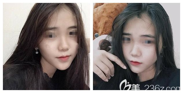 注射瘦臉術(shù)后一個(gè)月效果 注射瘦臉術(shù)后一個(gè)月效果