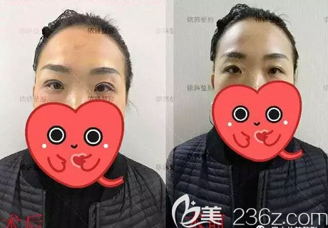 <!--<i data=20240703-sp></i>-->雙眼皮修復(fù)術(shù)前術(shù)后對(duì)比照片