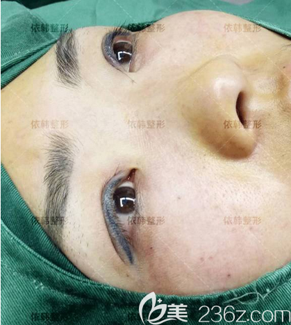 <!--<i data=20240703-sp></i>-->雙眼皮修復(fù)術(shù)后即刻照片