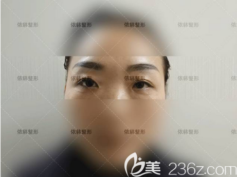 打聽到巴中哪里有割雙眼皮且做的好的醫(yī)院后，我就直奔做了雙眼皮眼部修復(fù)手術(shù)