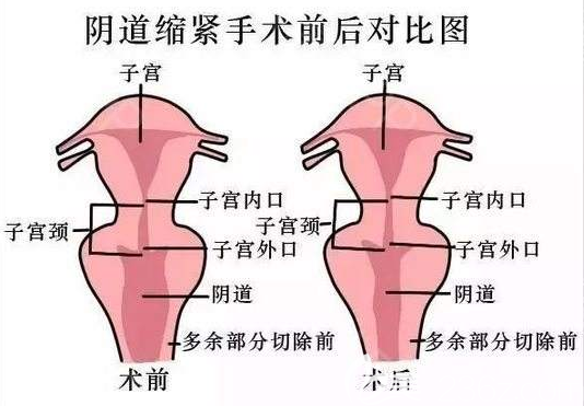 陰道緊縮手術(shù)前后效果對比圖