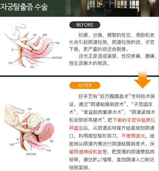 韓國好手藝后方膣圓蓋術(shù)縮陰效果對比示意圖