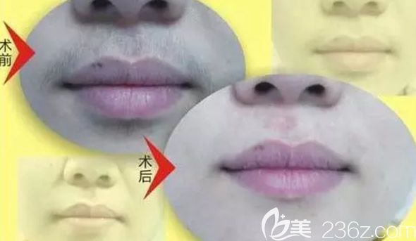 蘭州時光整形醫(yī)院柳軍醫(yī)生胡子激光脫毛案例